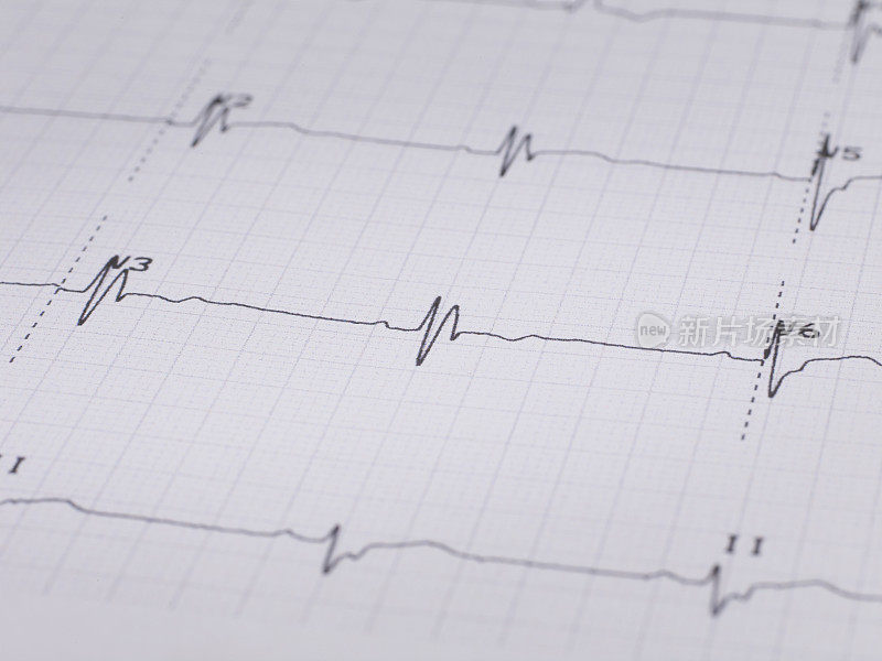 心电图(ECG)