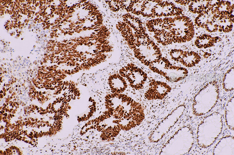 显微镜图像结肠癌