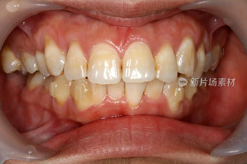 18个月后矫正牙齿(正面图)