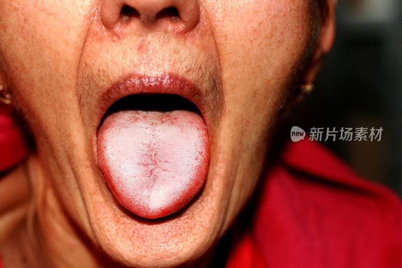 舌头呈白色。舌念珠菌病