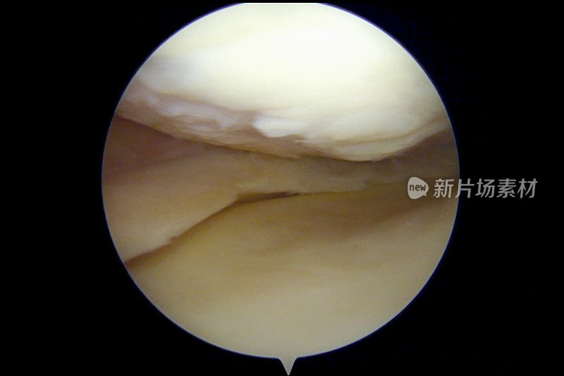 膝关节轻度至中度骨关节炎的关节镜观察