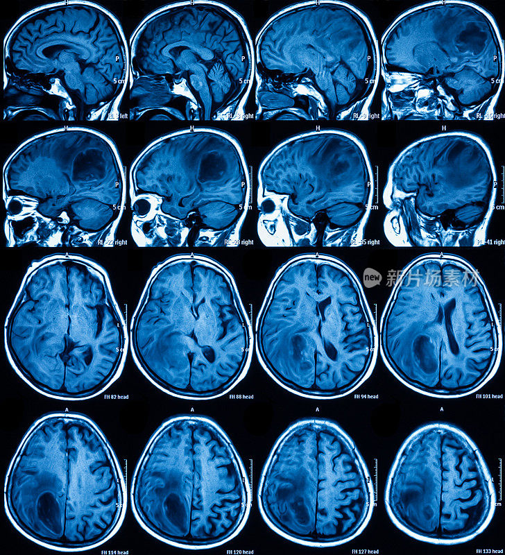 脑磁共振成像(MRI)，脑瘤
