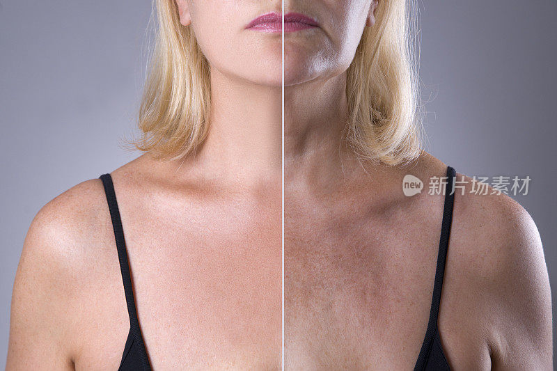 女性皮肤前拉皮和整形手术后，除皱治疗