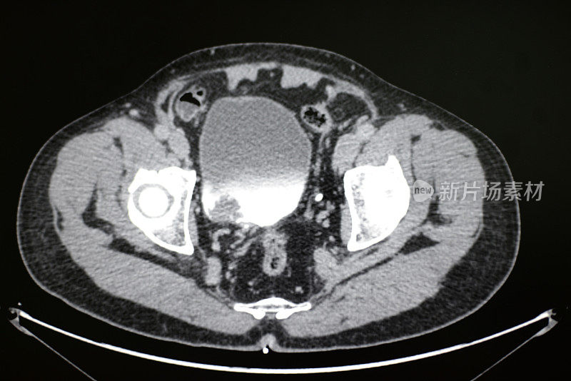 膀胱癌的CT影像