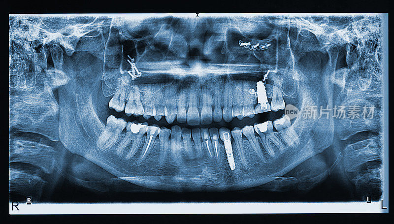 人类口腔x光片显示植牙