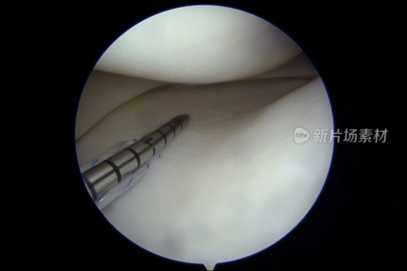 用全内技术修复内侧半月板后部桶柄撕裂的关节镜观察