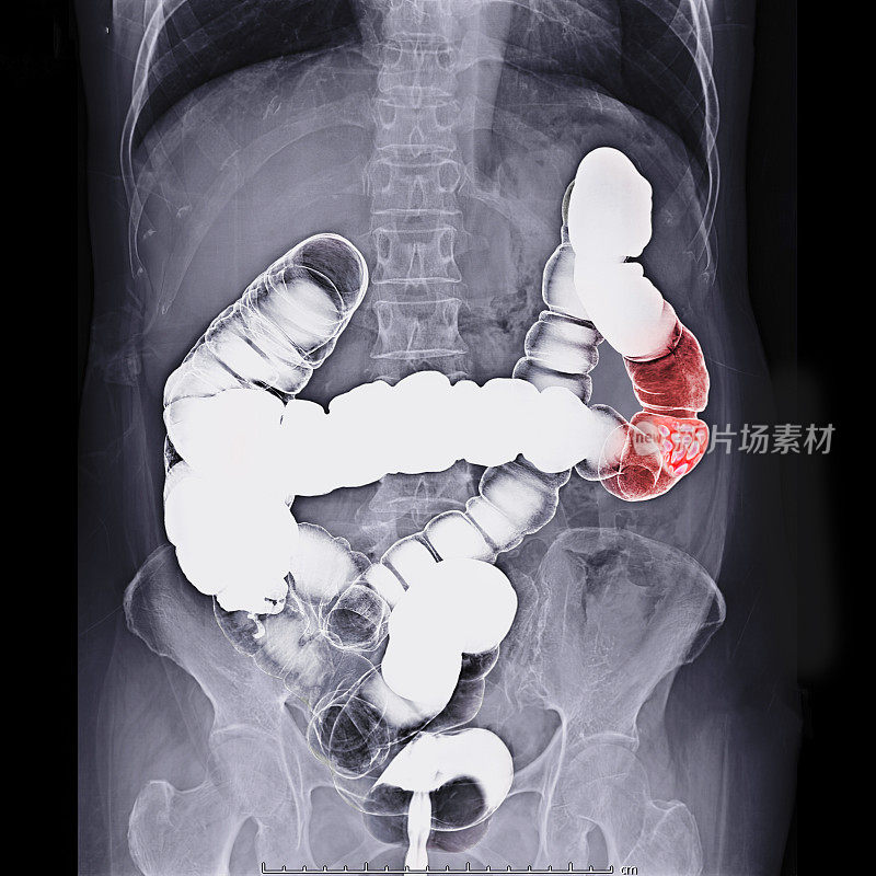 大肠钡剂灌肠片或x线片，俯卧位显示结肠解剖结构以检测结肠癌。剪切路径。