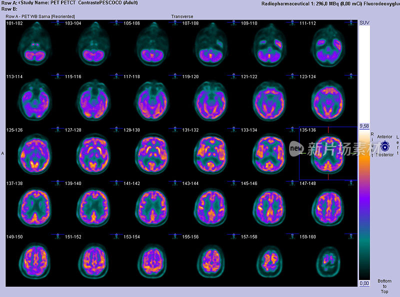 PET-CT脑部轴向扫描