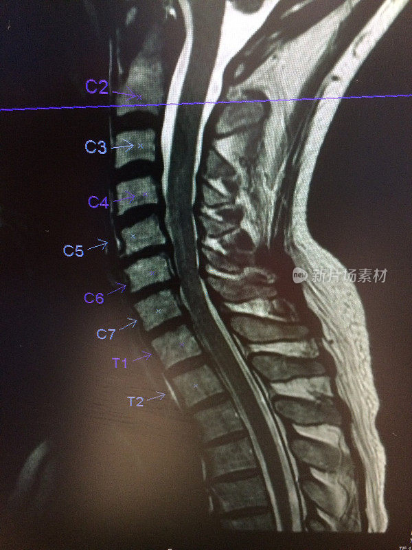 MRI显示颈椎有狭窄