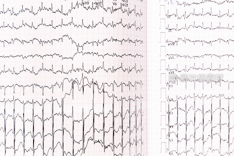 图表心电图(ECG)