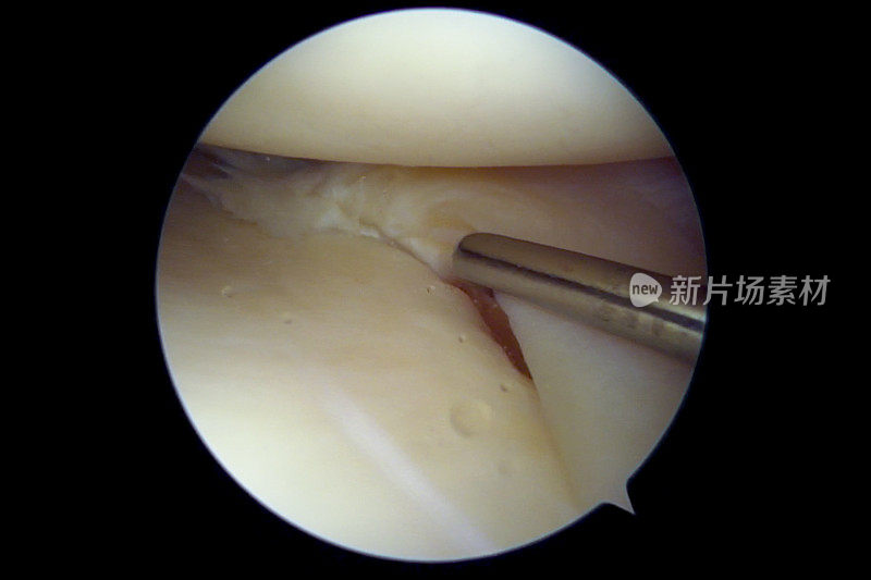右膝内侧半月板后部皮瓣撕裂的关节镜观察