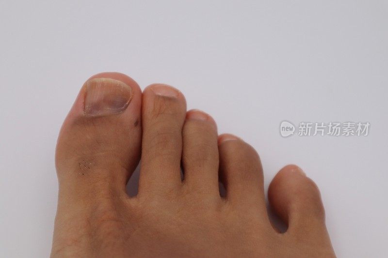 脚上因受伤而有黑指甲