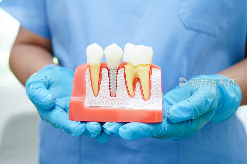 医生手持种植牙，人工牙根入颌，牙根管治疗，牙龈疾病，牙齿模型供牙医学习牙科。