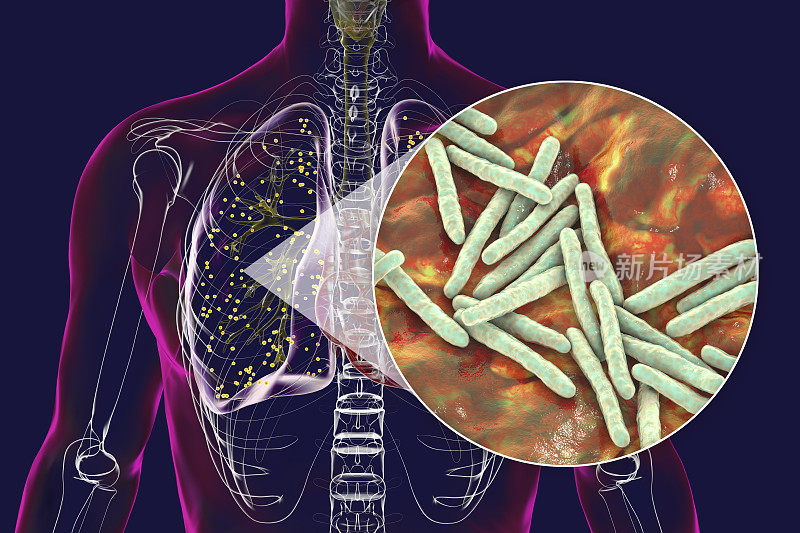 受军旅结核影响的人体肺部，与结核分枝杆菌细菌的特写视图，3D插图