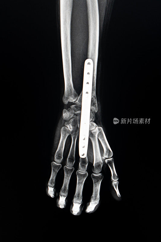 手部x光和用铂金固定手腕骨折。关节固定术