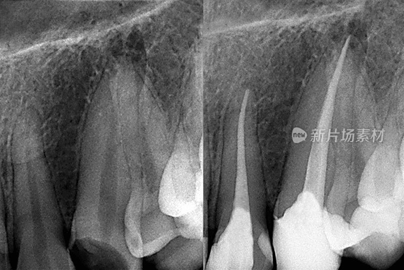 牙科x光片治疗前后
