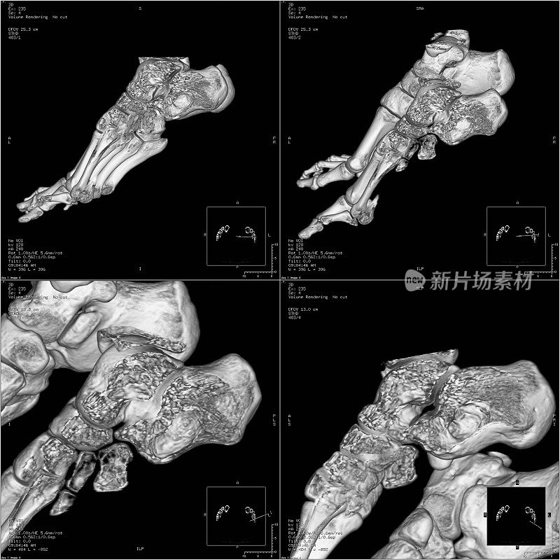 足部骨的三维CT