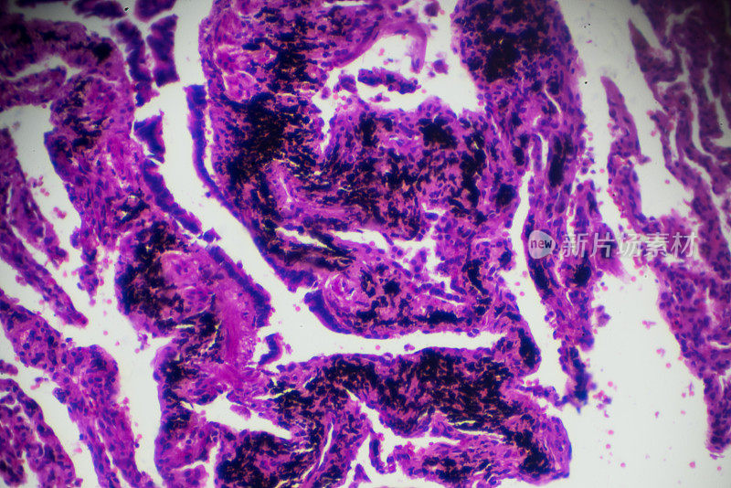 显微镜下烟肺有黑色沉积物
