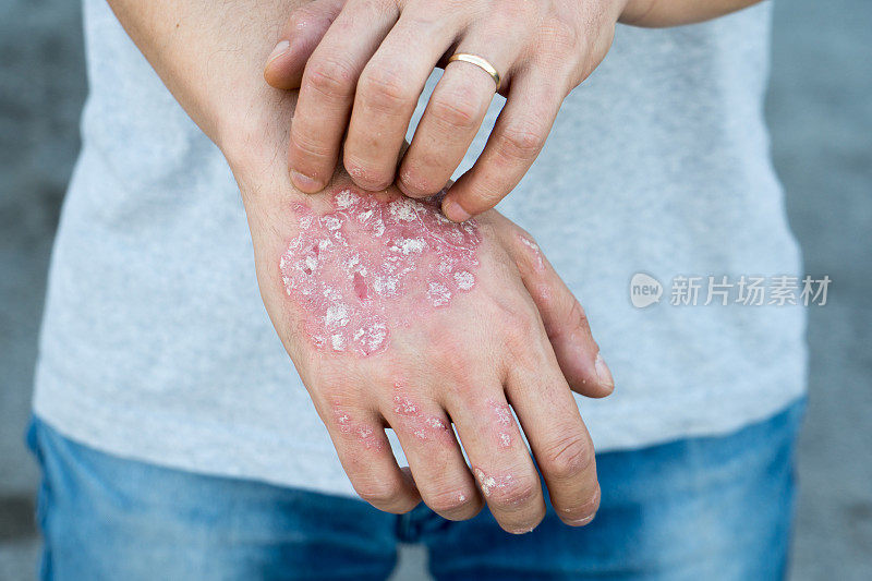 患有寻常型银屑病、湿疹和其他皮肤疾病(如真菌、斑块、皮疹和斑)的人会抓挠自己，手上出现干燥的片状皮肤。自体免疫的基因疾病。