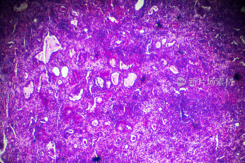 显微镜下硬化性肾小球肾炎活检标本