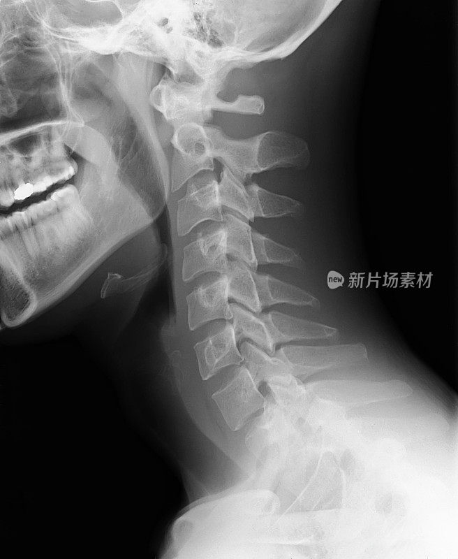 颈椎x线片