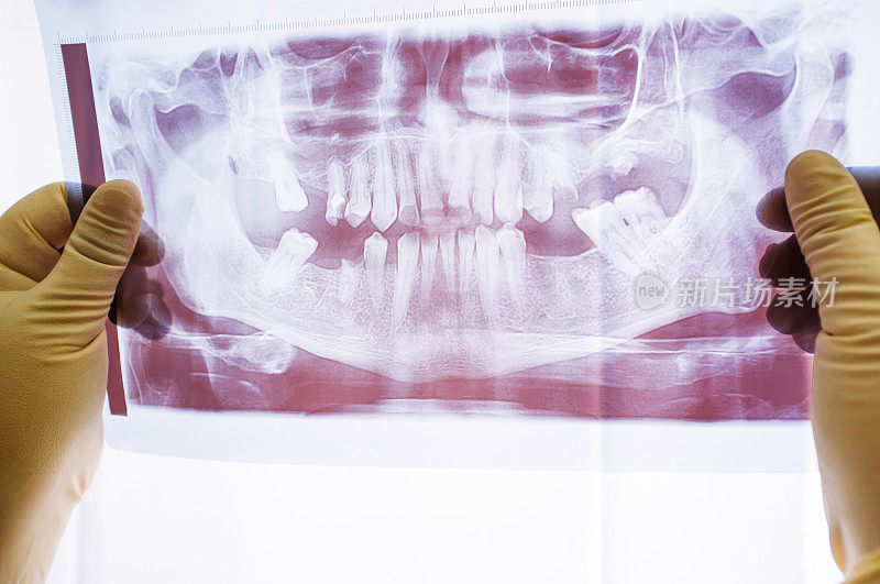 牙科x光检查与牙周炎问题