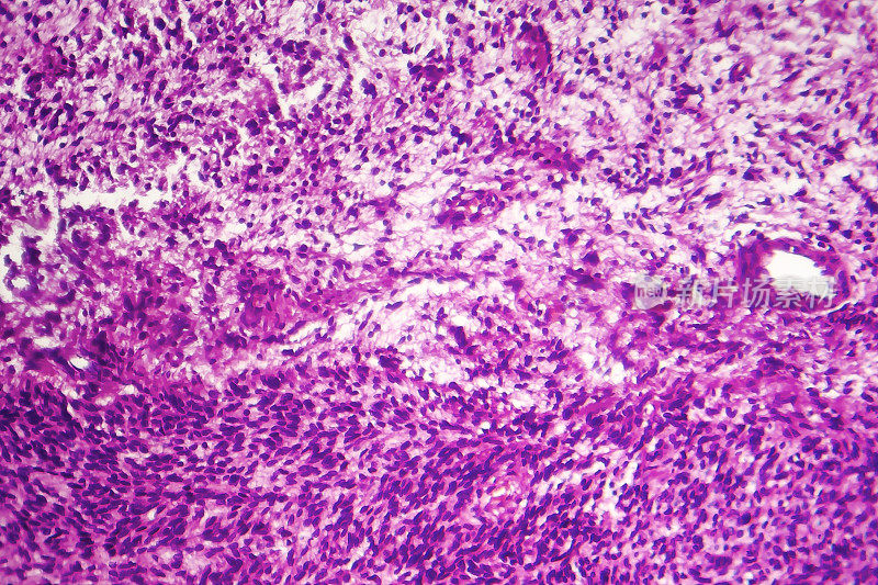 纤维肉瘤，成纤维细胞的恶性肿瘤