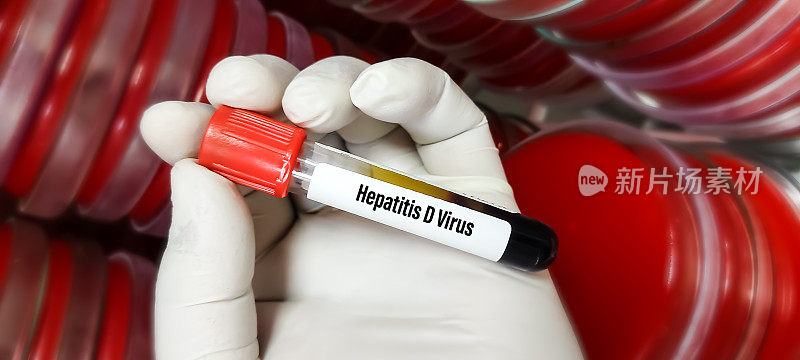 D型肝炎病毒(HDV)血液样管，实验室背景，聚焦图