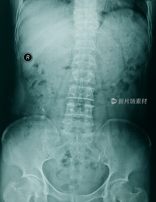 胸部x光图像