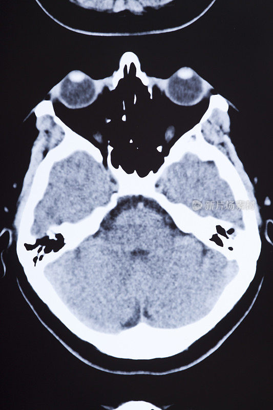 医学MRI图像显示大脑和头骨