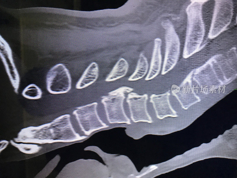 颈椎CT扫描的节段性OPLL