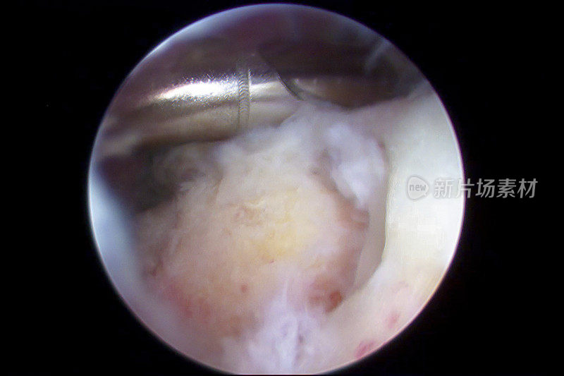 肩关节镜下观察肩袖撕裂