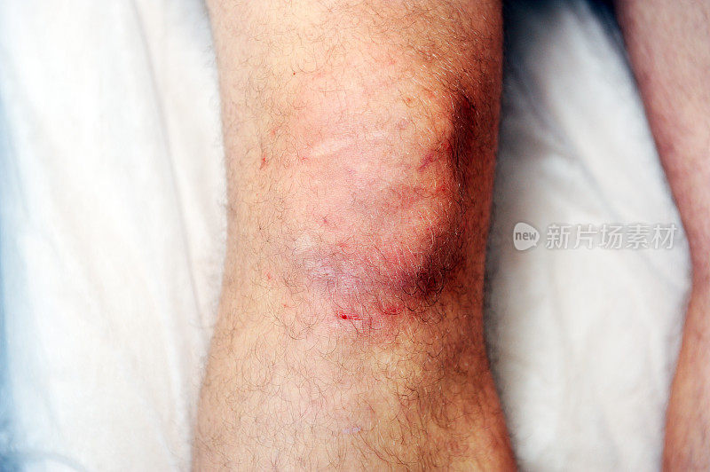 二氧化碳疗法(羧酸疗法)后膝关节皮肤发红