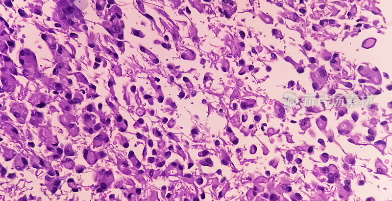 髓内SOL显微组织学分析显示星形细胞瘤，WHO分级4级