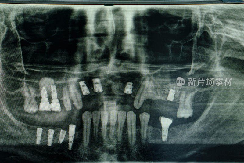 全景x线摄影(正位断层摄影)，显示牙齿结构的x光片