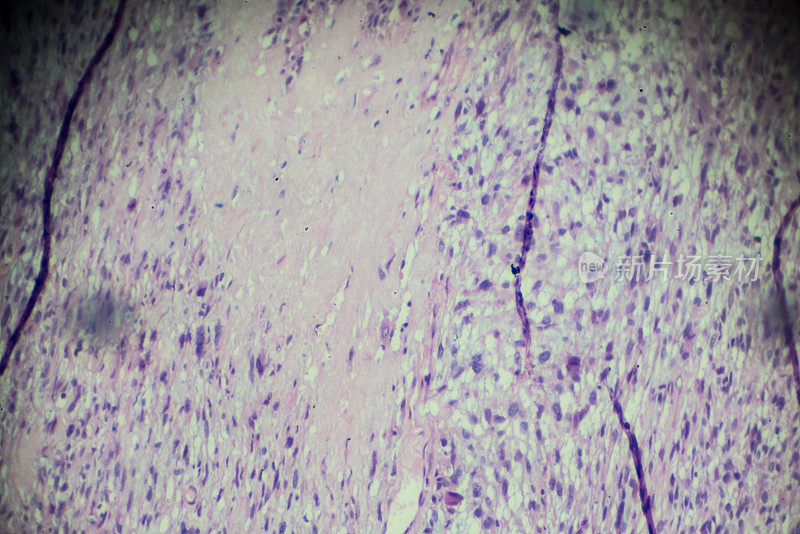 显微镜下横纹肌肉瘤活检