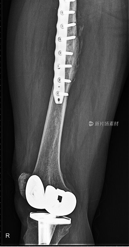 术后股骨骨折及人工膝关节