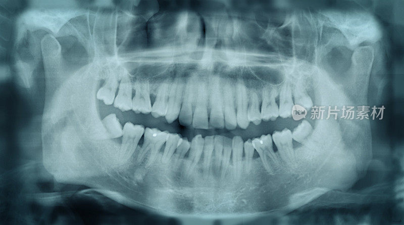 弯曲的牙齿x射线