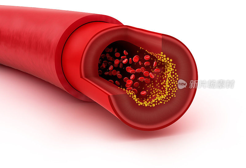 血管中的胆固醇斑块，3D插图