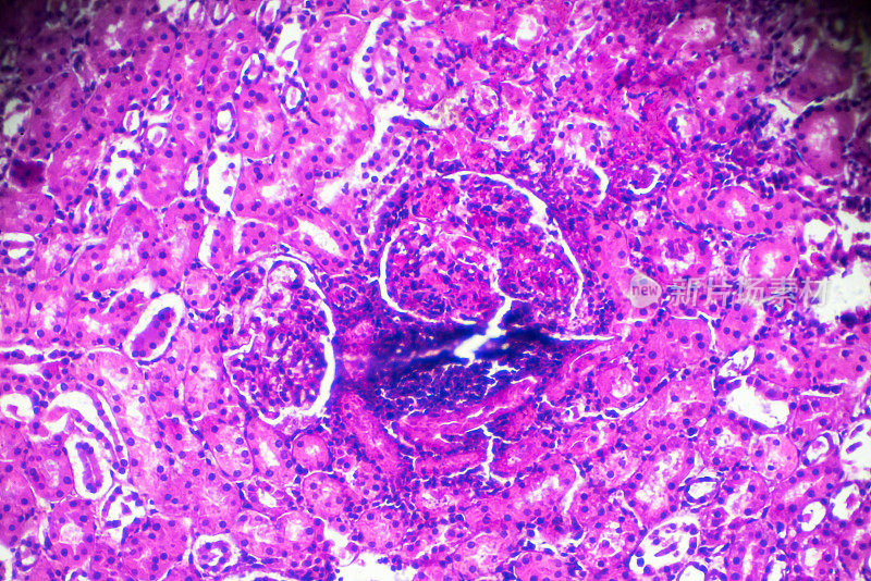 显微镜下急性肾盂肾炎活检标本