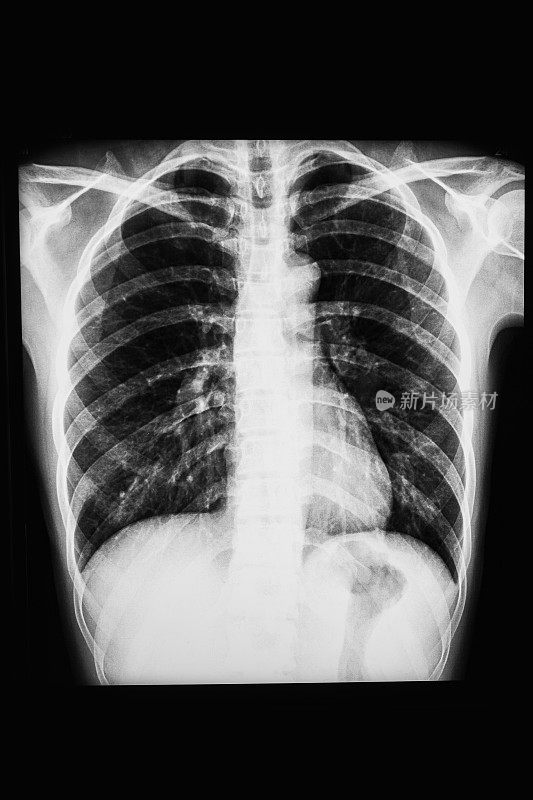 x射线成人身体肺扫描