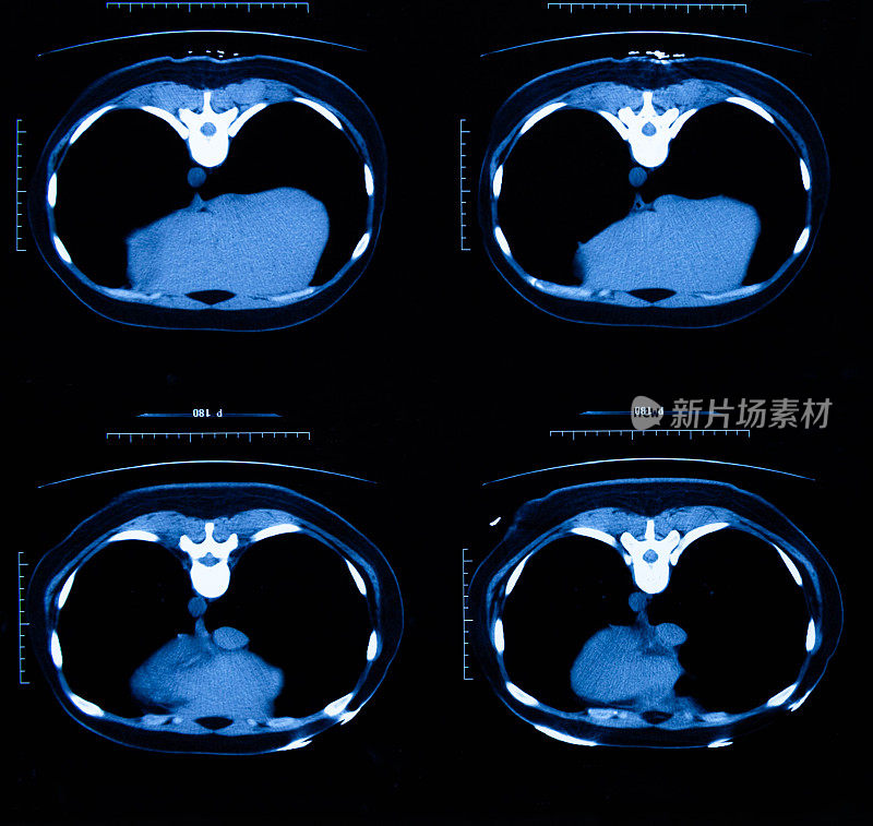 MRI胸腔体层摄影