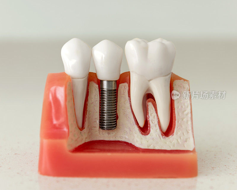 牙种植模型