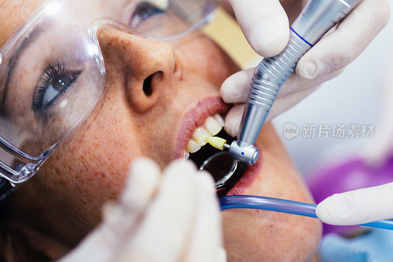 一个牙齿疾病患者口腔清洁的特写。用预防性眼镜治疗病人的牙齿。