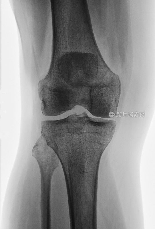 膝关节软骨损伤的RX