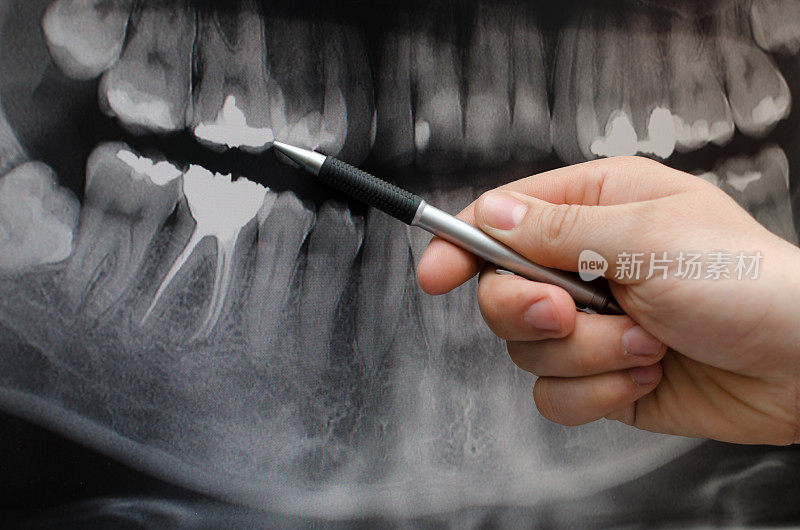 牙科医生在牙科x光图像上显示了一些东西