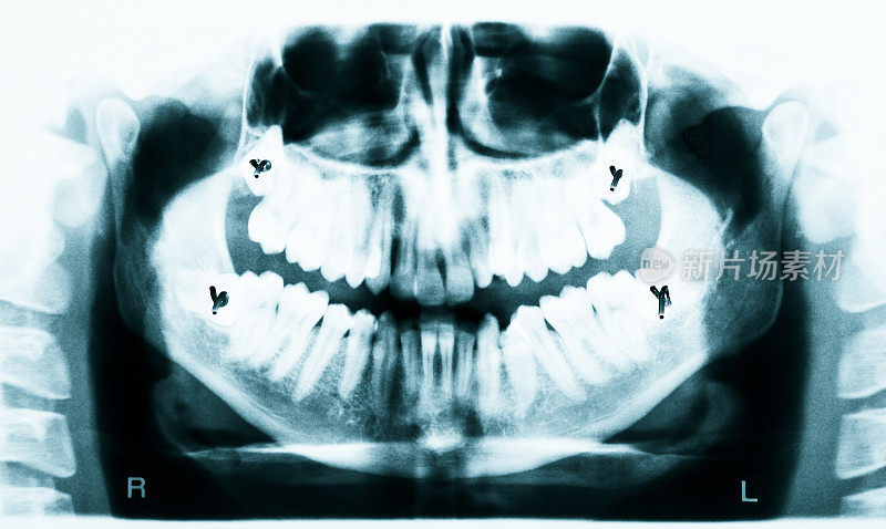 牙齿x射线