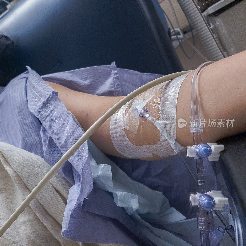 在医院接受过手术的成熟女性手臂上的输液器