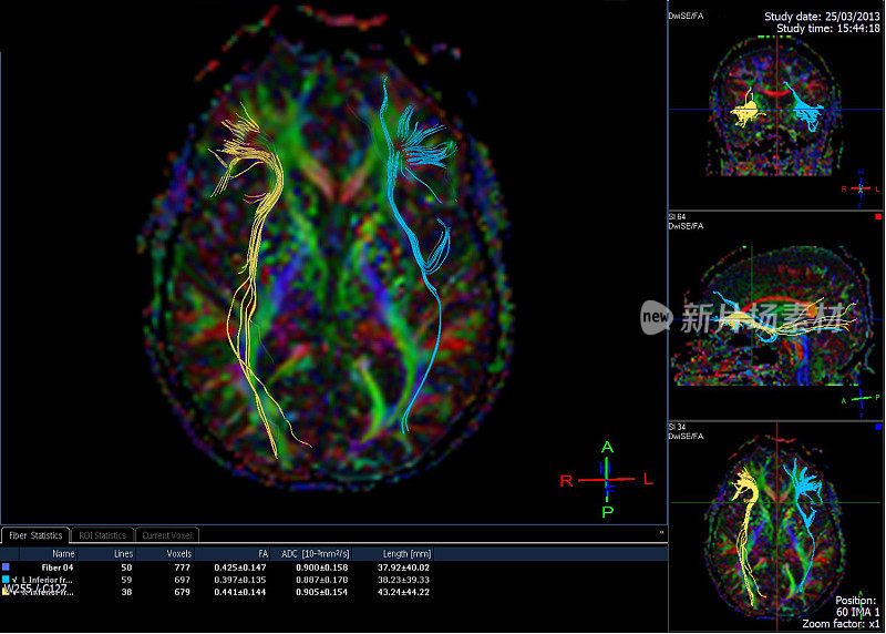 脑束造影(DTI-弥散张量成像MRI)