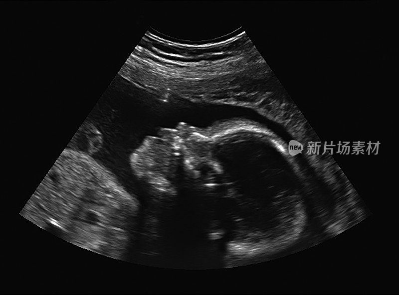 孕妇胎儿超声检查